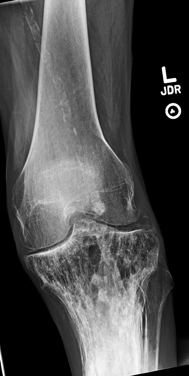 Figure 2 for case Pagets disease ( RID3815 )